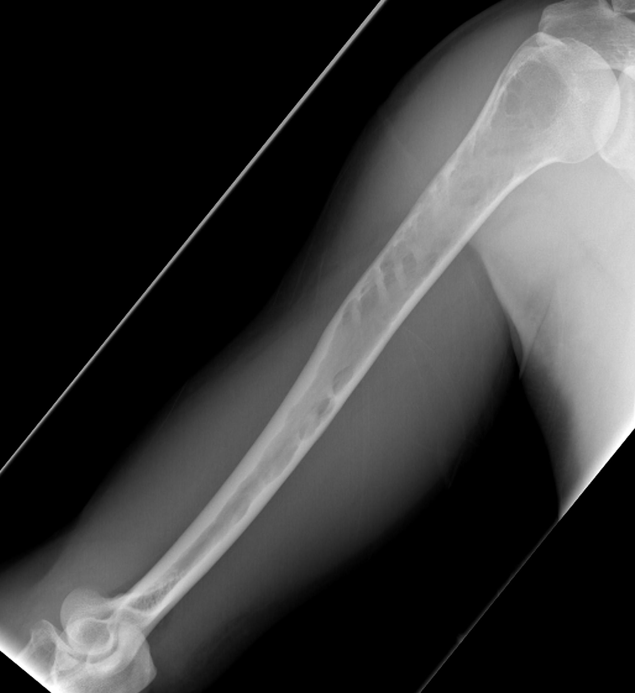 Myeloma Humerus